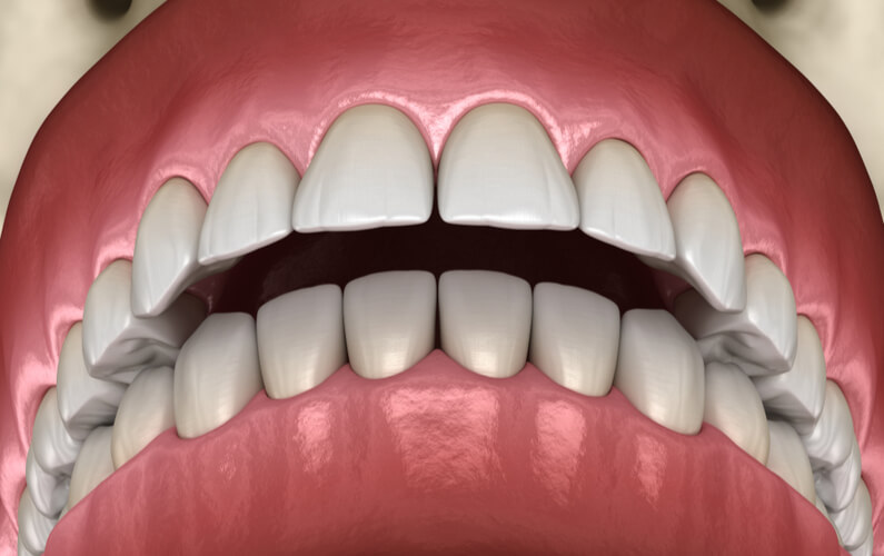 https://www.mybrownstonedental.com/wp-content/uploads/2022/01/overbite-in-teeth.jpg