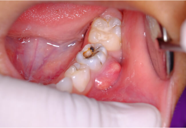 Tooth Infection Spreading Treatments When To See A Doctor