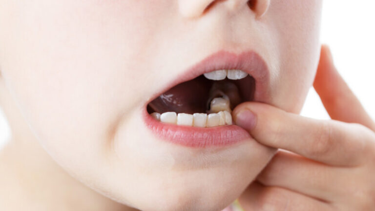 Tooth Infection Spreading Treatments When To See A Doctor