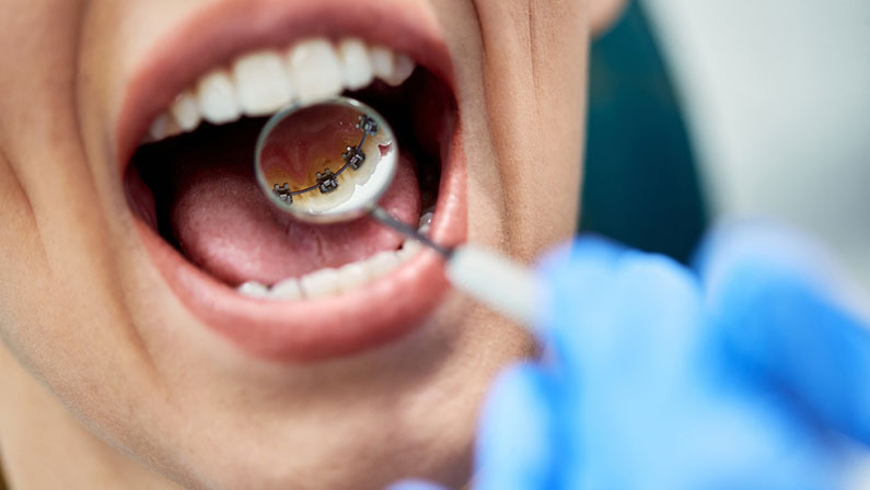 Close0up of woman having inner dental braces check-up at dentist's office.