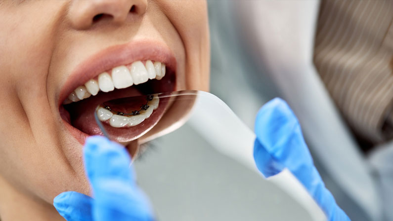 Close-up of orthodontist examining lingual braces of female patient with a mirror during dental check-up.