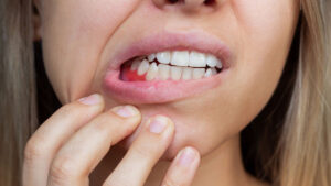 Gum inflammation. Close-up of a young woman showing bleeding gums. Dentistry, dental care