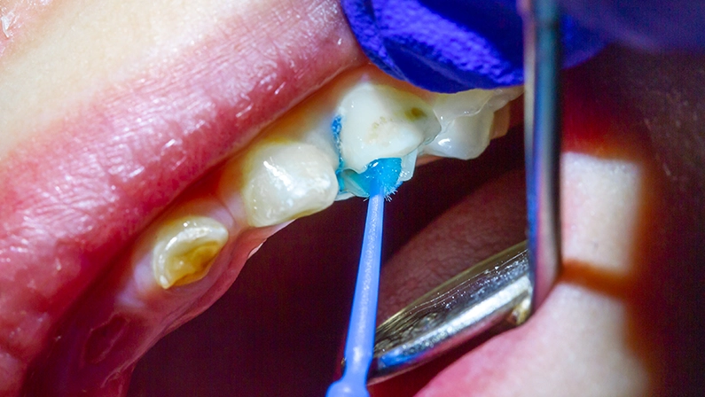 Treatment of baby teeth in a child, dental drill, installation and filling of canals, dental sealant and photopolymer filling.