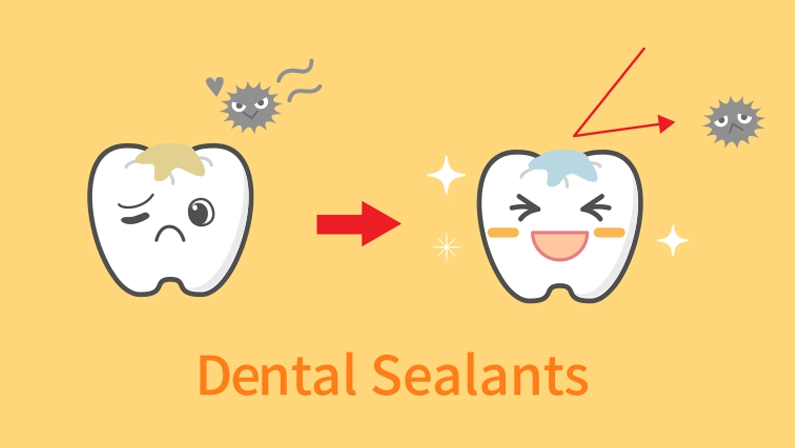 illustrations of dental sealants treatment before after