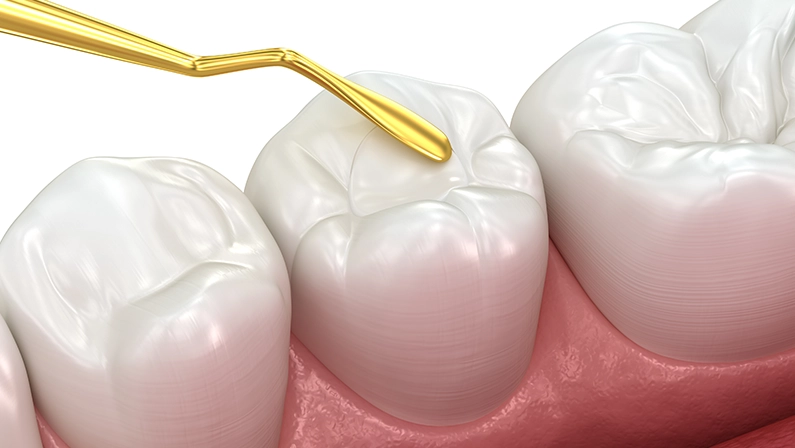 Toth restoration with filling. Medically accurate tooth 3D illustration.