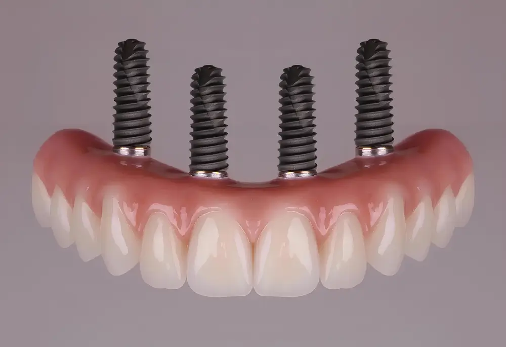 The All-on-4 treatment concept for full-arch dental prostheses in completely edentulous jaws