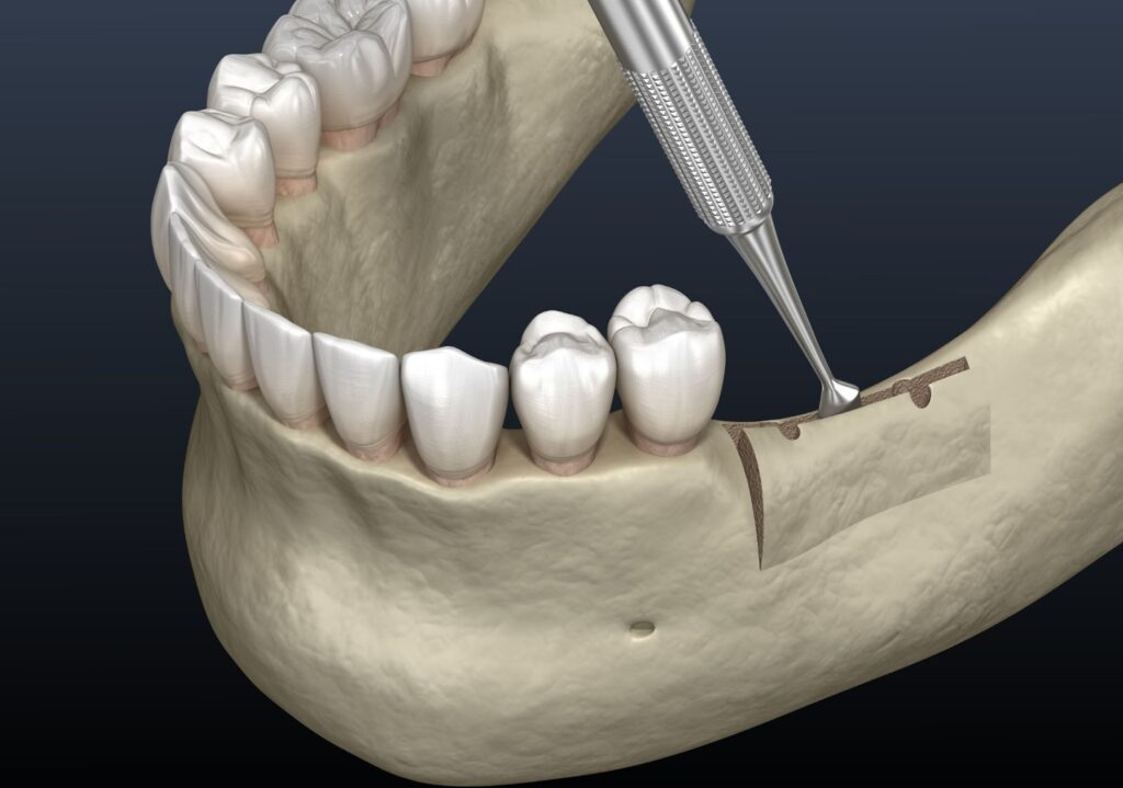 A Complete Guide to Alveoloplasty