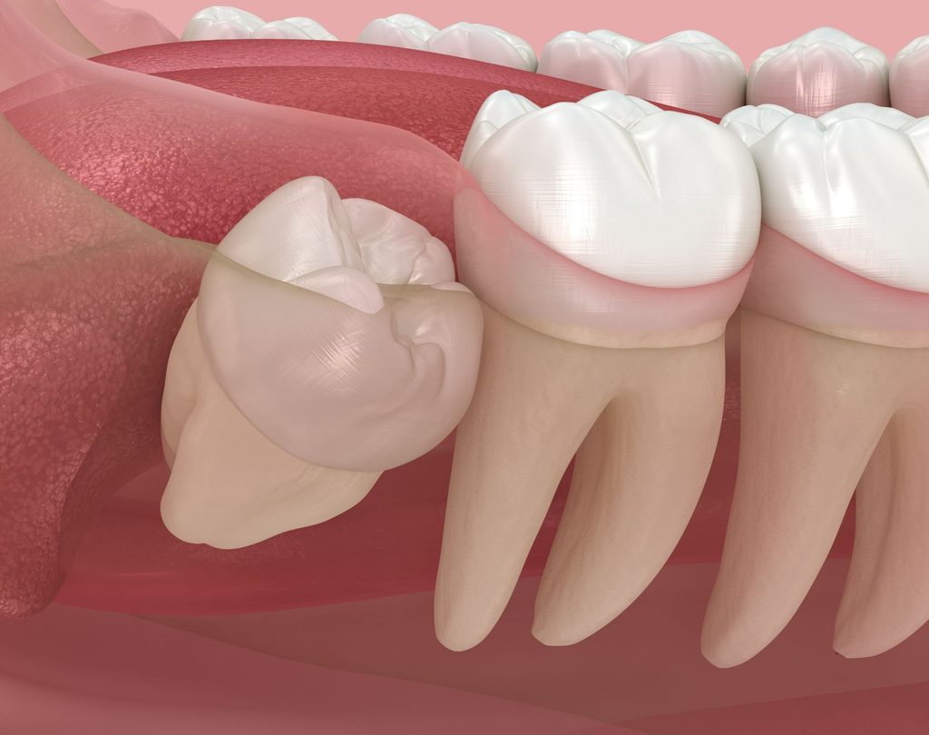 Impacted Wisdom Teeth
