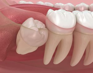 Impacted Wisdom Teeth